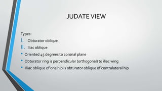 JUDATEVIEW
Types:
I. Obturator oblique
II. Iliac oblique
• Oriented 45 degrees to coronal plane
• Obturator ring is perpendicular (orthogonal) to iliac wing
• Iliac oblique of one hip is obturator oblique of contralateral hip
 