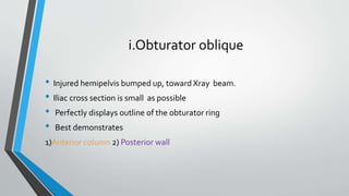 i.Obturator oblique
• Injured hemipelvis bumped up, toward Xray beam.
• Iliac cross section is small as possible
• Perfectly displays outline of the obturator ring
• Best demonstrates
1)Anterior column 2) Posterior wall
 