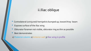 ii.Iliac oblique
• Contralateral (uninjured) hemipelvis bumped up, toward Xray beam
• Exposes surface of the iliac wing
• Obturator foramen not visible, obturator ring as thin as possible
• Best demonstrates
1) Posterior column 2) Anterior wall 3) Iliac wing in profile
 