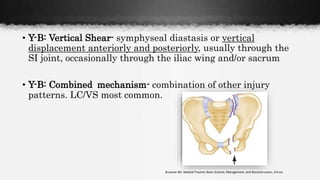 • Y-B: Vertical Shear- symphyseal diastasis or vertical
displacement anteriorly and posteriorly, usually through the
SI joint, occasionally through the iliac wing and/or sacrum
• Y-B: Combined mechanism- combination of other injury
patterns. LC/VS most common.
Browner BD: Skeletal Trauma: Basic Science, Management, and Reconstruction, 3rd ed.
 