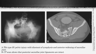 A Tile type B1 pelvic injury with diastasis of symphysis and anterior widening of sacroiliac
joint.
B CT scan shows that posterior sacroiliac joint ligaments are intact.
FracturesofAcetabulumandPelvis-Campbell'sOperativeOrthopaedics.Guyton,JamesL.;Perez,Edward
A..PublishedJanuary2,2013.Pages2777-2828.e5.©2013.
 