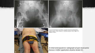 Fractures of Acetabulum and Pelvis- Campbell's Operative Orthopaedics.
Guyton, James L.; Perez, Edward A.. Published January 2, 2013. Pages 2777-
2828.e5. © 2013.
A Initial anteroposterior radiograph of open-book pelvic
fracture. B After application of pelvic binder (C) .
 