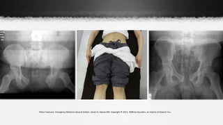Pelvic Fractures- Emergency Medicine Second Edition. James G. Adams MD. Copyright © 2013, 2008 by Saunders, an imprint of Elsevier Inc.
 
