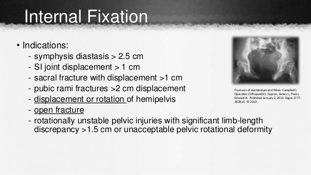 Single Ring Stable Pelvic Fracture Single Ring Stable Pelvic Fracture