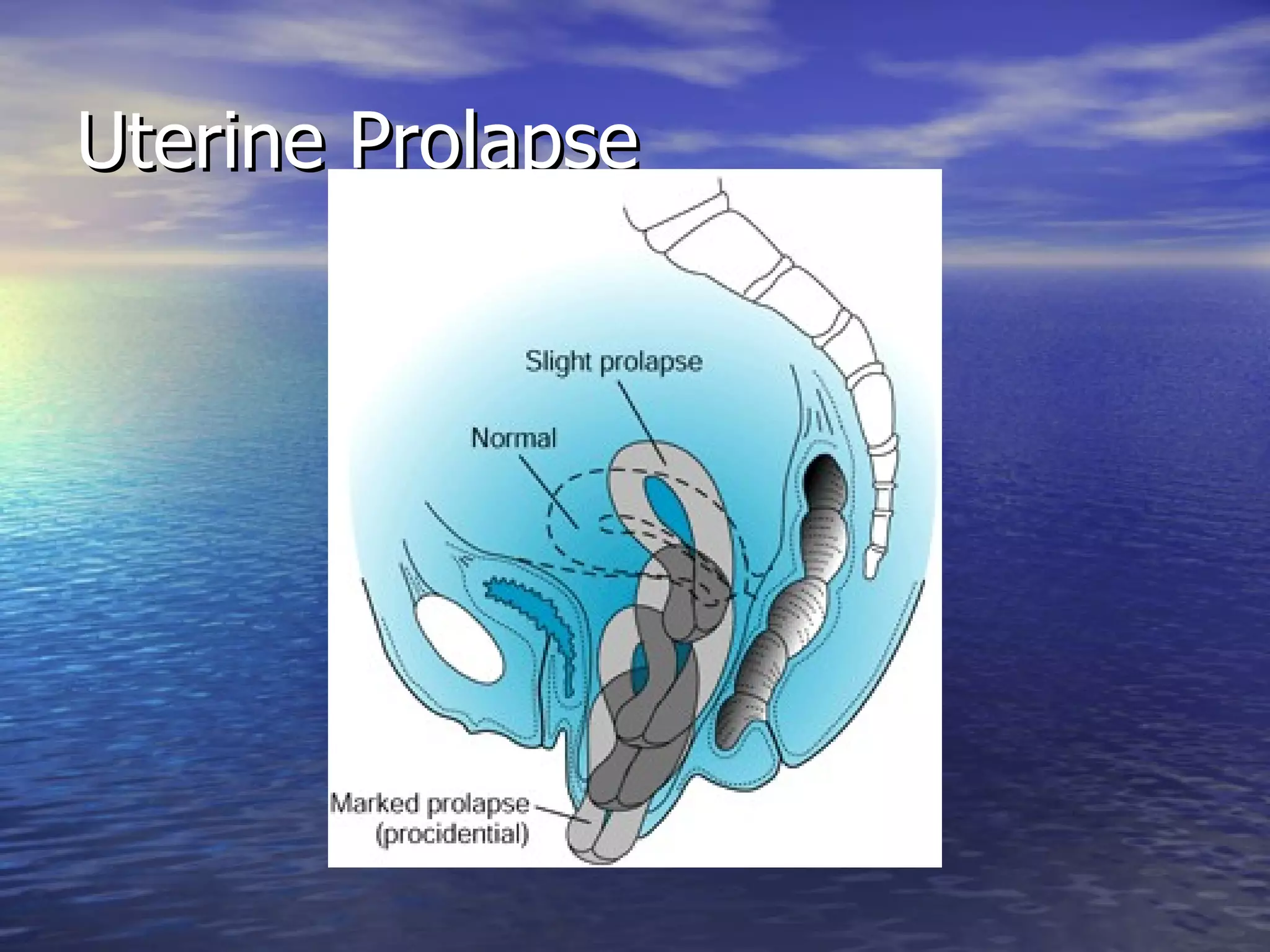 Pelvik Organ Prolapsusunda Tanı ve Tedavi - www.jinekolojivegebelik.com