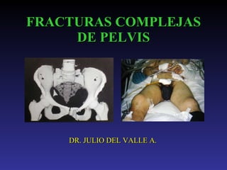 FRACTURAS   COMPLEJAS   DE PELVIS DR. JULIO DEL VALLE A. 