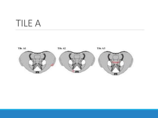 TILE A
 