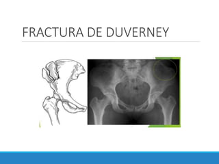 FRACTURA DE DUVERNEY
 