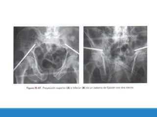 FRACTURAS DE PELVIS