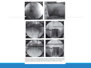 FRACTURAS DE PELVIS