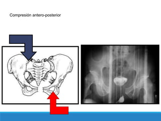 Compresión antero-posterior
 
