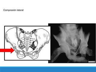 Compresión lateral
 