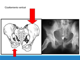 Cizallamiento vertical
 