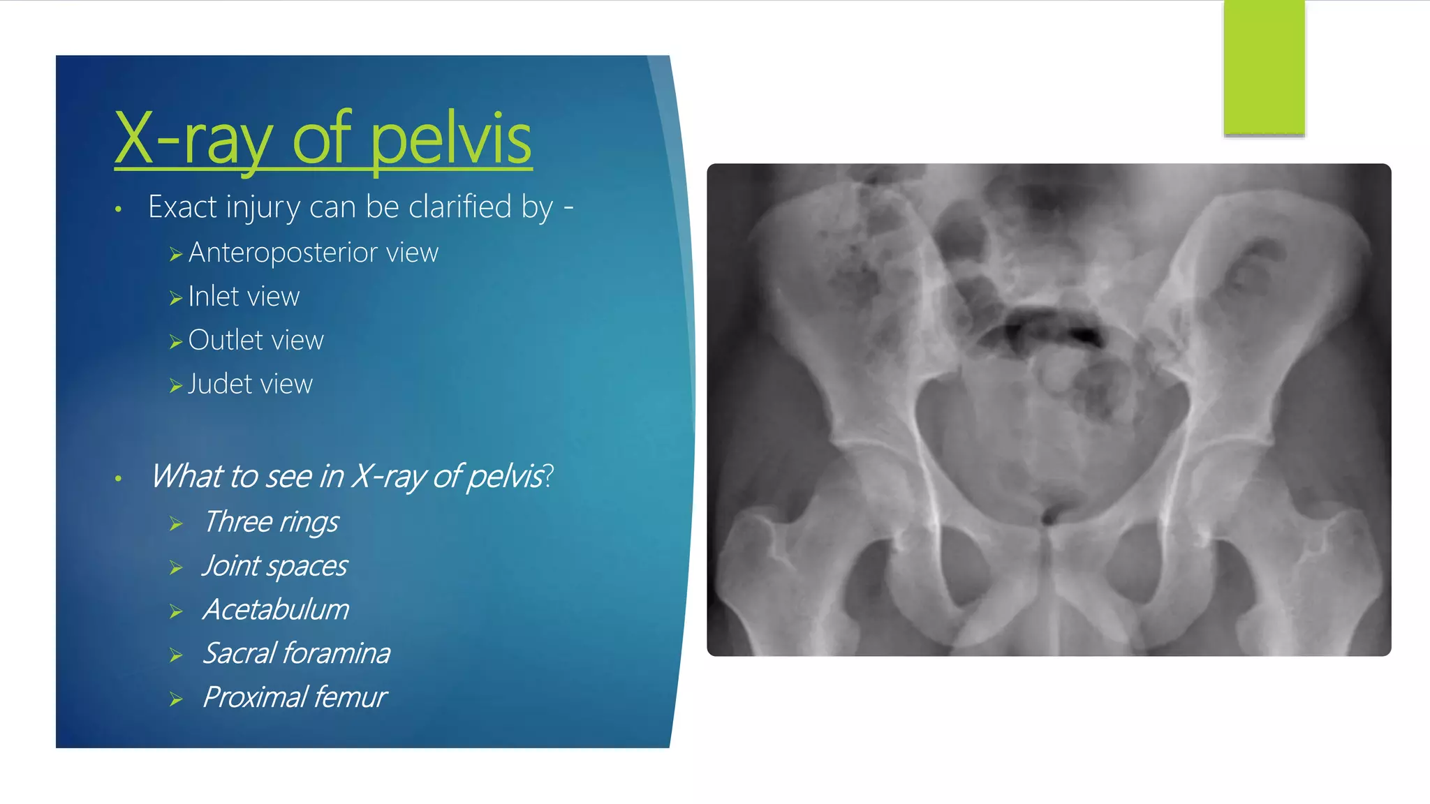 Pelvis fracture dislocation | PPTX