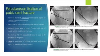 Pelvis fracture dislocation | PPTX