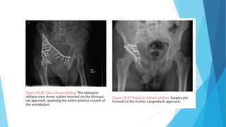 PELVIS & ACETABULUM Orthopaedics topics slides | PPTX