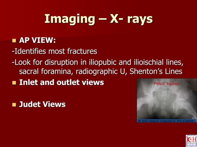 Pelvis acetabulum - anatomy , imaging , classification | PPTX