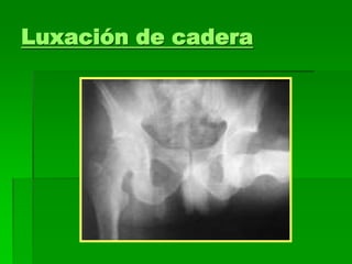 Luxación de cadera
 