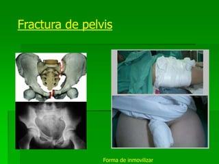 Fractura de pelvis
Forma de inmovilizar
 