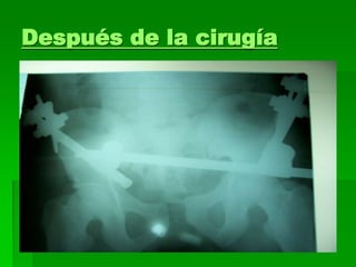 Después de la cirugía
 