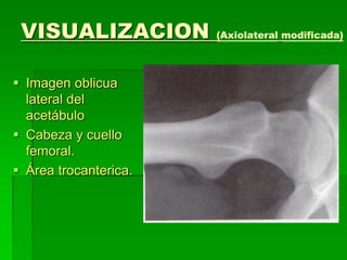 VISUALIZACION (Axiolateral modificada)
 Imagen oblicua
lateral del
acetábulo
 Cabeza y cuello
femoral.
 Área trocanterica.
 