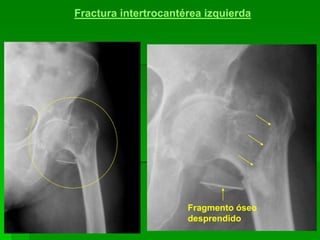 141
Fractura intertrocantérea izquierda
Fragmento óseo
desprendido
 