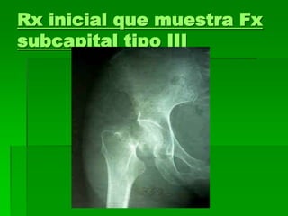 Rx inicial que muestra Fx
subcapital tipo III
 
