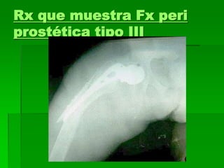 Rx que muestra Fx peri
prostética tipo III
 