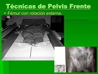 Técnicas de Pelvis Frente
 Fémur con rotación externa.
 