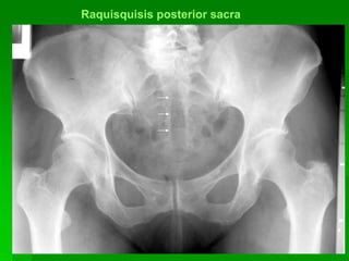 25
Raquisquisis posterior sacra
 