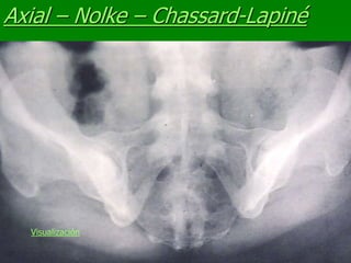 Axial – Nolke – Chassard-Lapiné
Visualización
 