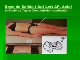 Rayo de Salida ( Aut Let) AP. Axial
(método de Taylor Zona inferior localizada)
 