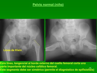 75
Pelvis normal (niño)
Línea de Klein
Esta línea, tangencial al borde externo del cuello femoral corta una
parte importante del núcleo cefálico femoral.
Este segmento debe ser simétrico (permite el diagnóstico de epifisiolisis)
 