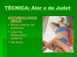 TÉCNICA: Alar o de Judet
ACETABULO HACIA
ABAJO:
 Borde anterior del
acetábulo
 Columna
ilioisquiática
posterior.
 Ala iliaca.
 