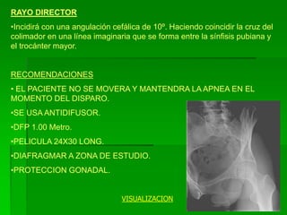 RAYO DIRECTOR
•Incidirá con una angulación cefálica de 10º. Haciendo coincidir la cruz del
colimador en una línea imaginaria que se forma entre la sínfisis pubiana y
el trocánter mayor.
RECOMENDACIONES
• EL PACIENTE NO SE MOVERA Y MANTENDRA LA APNEA EN EL
MOMENTO DEL DISPARO.
•SE USA ANTIDIFUSOR.
•DFP 1.00 Metro.
•PELICULA 24X30 LONG.
•DIAFRAGMAR A ZONA DE ESTUDIO.
•PROTECCION GONADAL.
VISUALIZACION
 