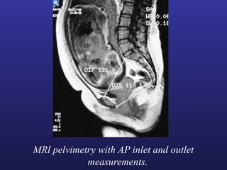 MRl pelvimetry with AP inlet and outlet
measurements.
 
