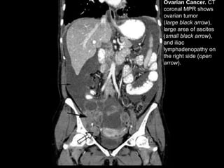 Ovarian Cancer. CT
coronal MPR shows
ovarian tumor
(large black arrow),
large area of ascites
(small black arrow),
and iliac
lymphadenopathy on
the right side (open
arrow).
 