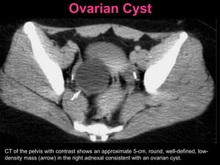 Ovarian Cyst
CT of the pelvis with contrast shows an approximate 5-cm, round, well-defined, low-
density mass (arrow) in the right adnexal consistent with an ovarian cyst.
 
