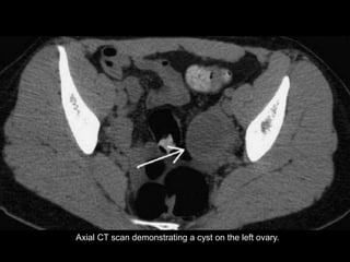 Axial CT scan demonstrating a cyst on the left ovary.
 