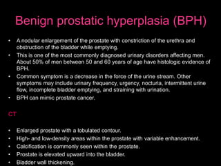 Benign prostatic hyperplasia (BPH)
• A nodular enlargement of the prostate with constriction of the urethra and
obstruction of the bladder while emptying.
• This is one of the most commonly diagnosed urinary disorders affecting men.
About 50% of men between 50 and 60 years of age have histologic evidence of
BPH.
• Common symptom is a decrease in the force of the urine stream. Other
symptoms may include urinary frequency, urgency, nocturia, intermittent urine
flow, incomplete bladder emptying, and straining with urination.
• BPH can mimic prostate cancer.
CT
• Enlarged prostate with a lobulated contour.
• High- and low-density areas within the prostate with variable enhancement.
• Calcification is commonly seen within the prostate.
• Prostate is elevated upward into the bladder.
• Bladder wall thickening.
 
