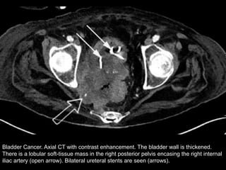Bladder Cancer. Axial CT with contrast enhancement. The bladder wall is thickened.
There is a lobular soft-tissue mass in the right posterior pelvis encasing the right internal
iliac artery (open arrow). Bilateral ureteral stents are seen (arrows).
 