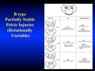 B type
Partially Stable
Pelvic Injuries
(Rotationally
Unstable)
 