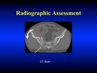 Radiographic Assessment
CT Scan
 