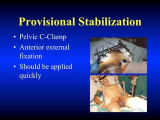 Provisional Stabilization
• Pelvic C-Clamp
• Anterior external
fixation
• Should be applied
quickly
 