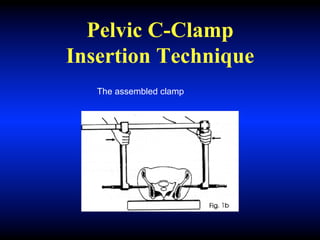 Pelvic C-Clamp
Insertion Technique
The assembled clamp
 