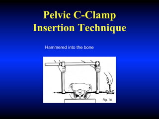 Pelvic C-Clamp
Insertion Technique
Hammered into the bone
 