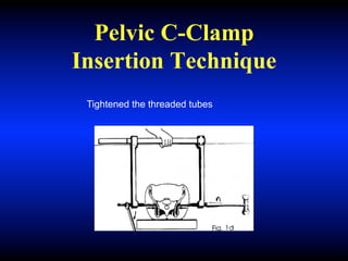 Pelvic C-Clamp
Insertion Technique
Tightened the threaded tubes
 