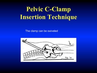 Pelvic C-Clamp
Insertion Technique
The clamp can be swiveled
 