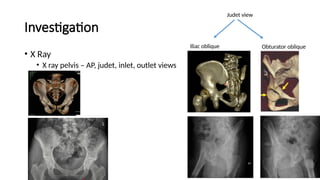 Pelvis fracture, classification and management | PPTX