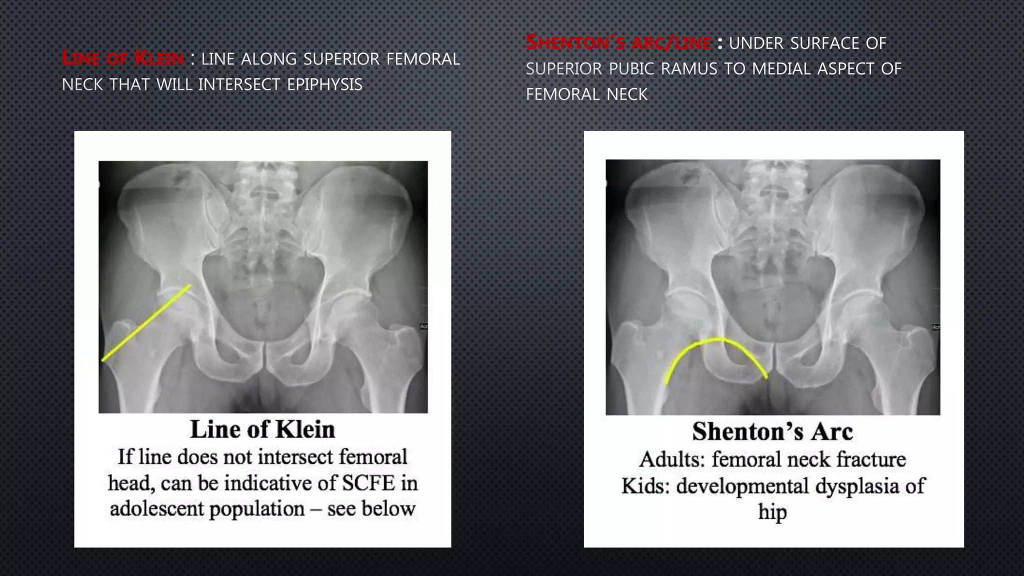 Pelvis fractures | PPTX